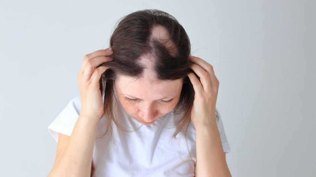 Things To Know About Alopecia Areata - SuccessYeti