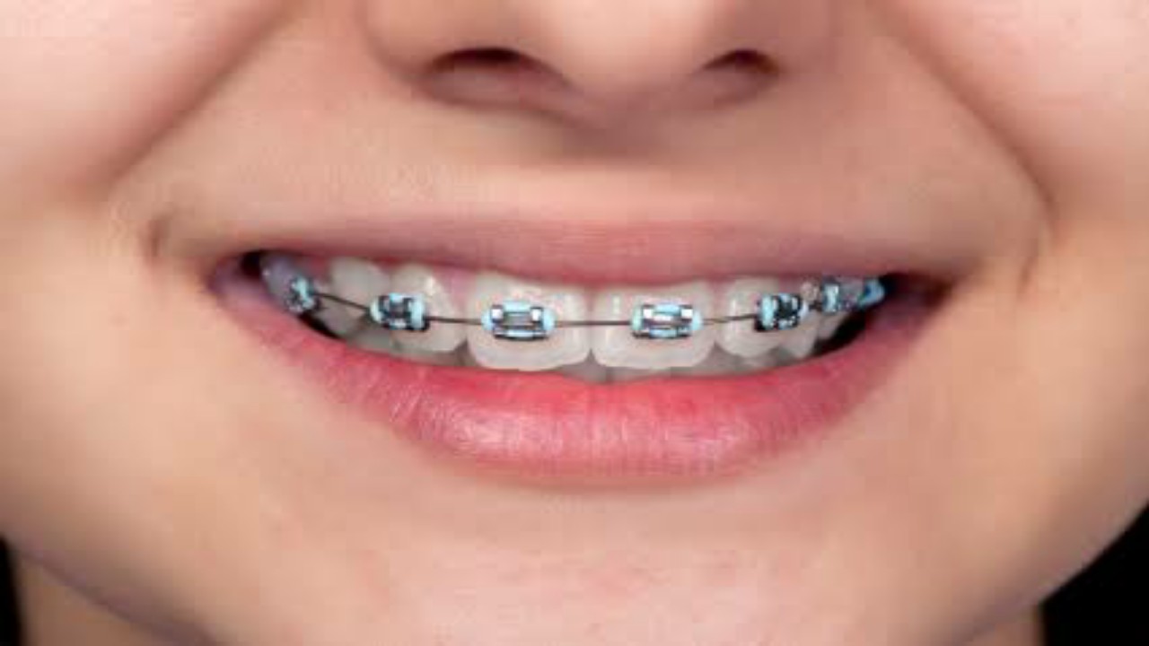 Braces Tgp