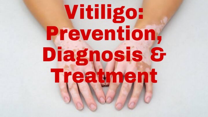 Vitiligo: Prevention, Diagnosis And Treatment - SuccessYeti