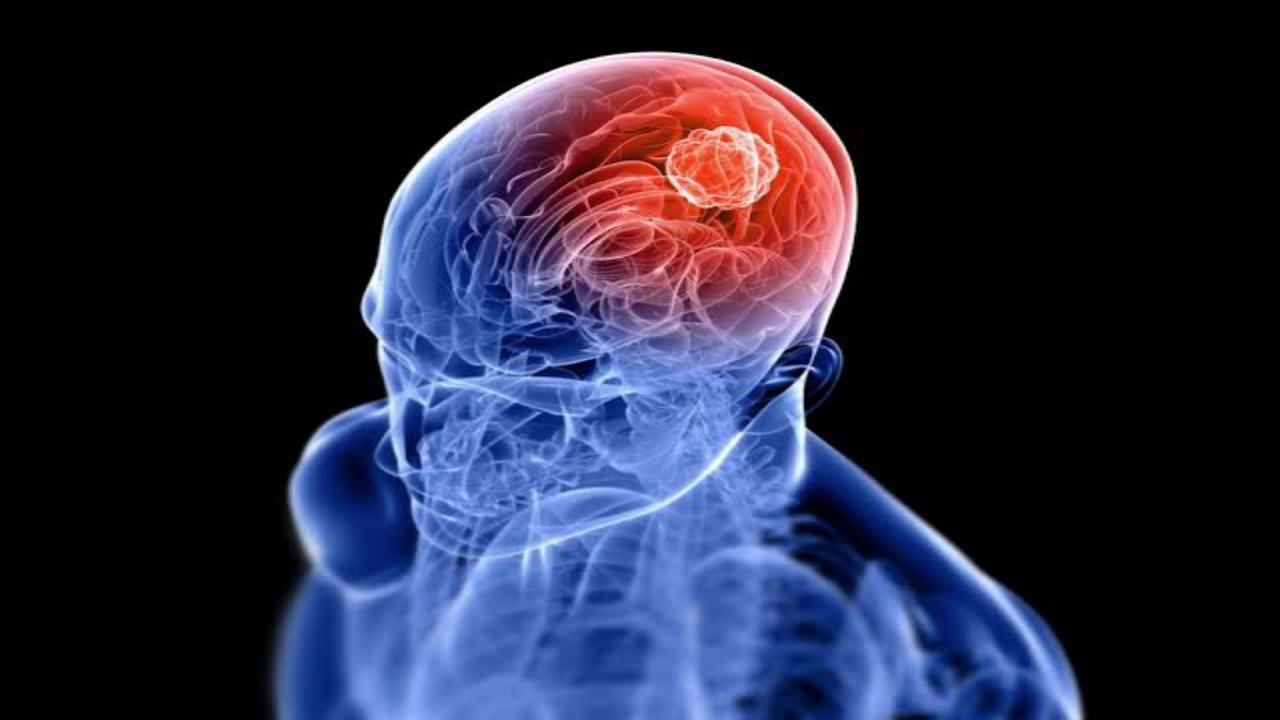 what-is-glioma-types-and-symptoms-successyeti