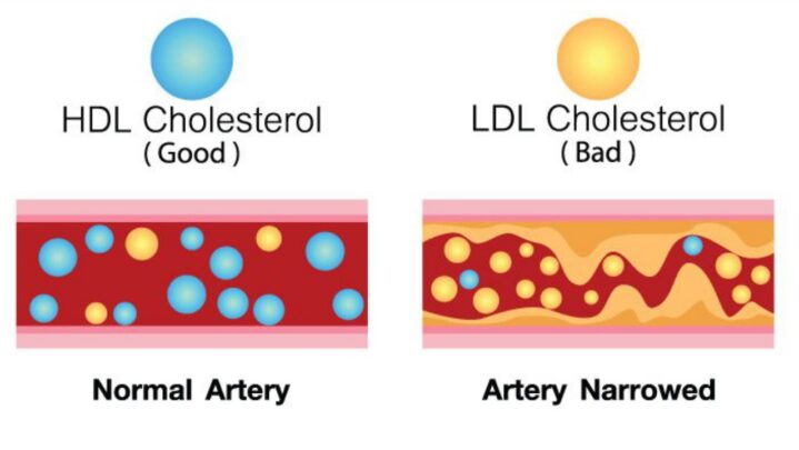 Good Cholesterol Vs Bad Cholesterol: Know The Difference - SuccessYeti