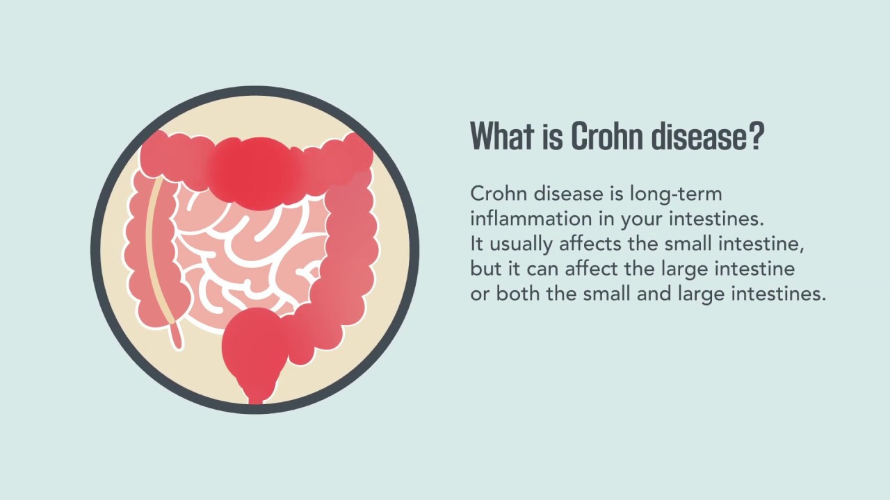 what-is-crohn-disease-successyeti