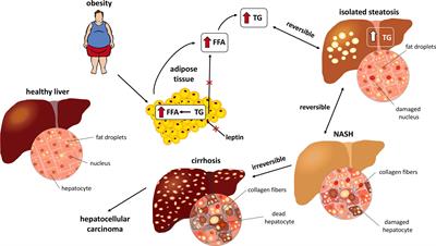 Vitamin B Use May Decrease The Progression Of Advanced Non-Alcoholic ...